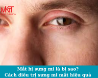 Mắt bị sưng mi là bị sao? Cách điều trị sưng mi mắt hiệu quả